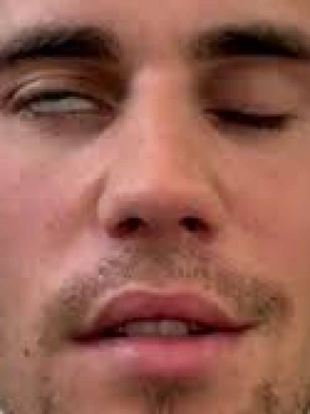 Understanding Ramsay Hunt Syndrome