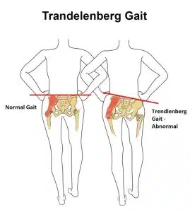 Trendelenburg Gait - Trendelenburg Test