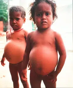 Flag Hair Sign in Kwashiorkor