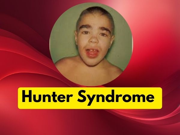 hunter syndrome - A rare genetic syndrome