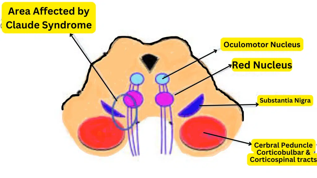 Claude Syndrome - What artery is affected by Claude syndrome